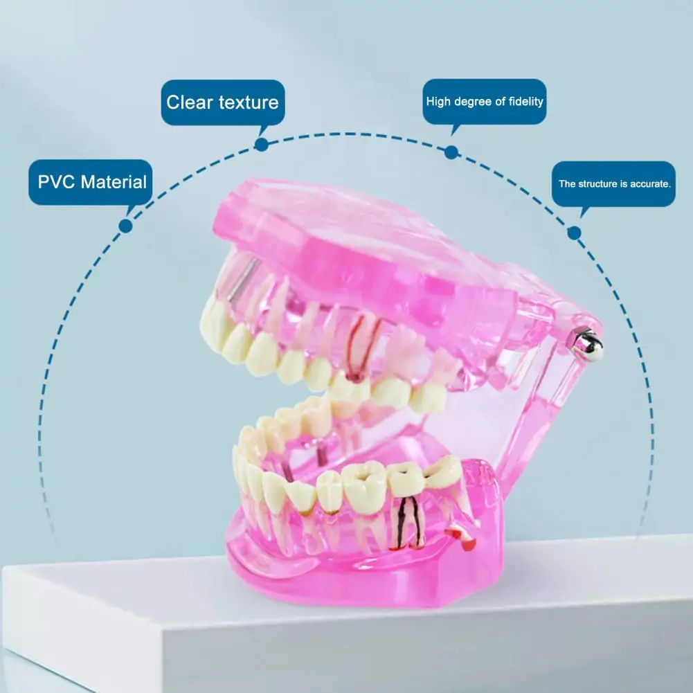 Modelo de implante Dental, ayuda para enseñanza de implantes dentales para estudiantes de dentista, dientes extraíbles, modelos de demostración de ortodoncia, prótesis - imagen 2